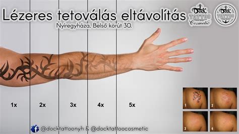 Lézeres tetoválás eltávolítás folyamata